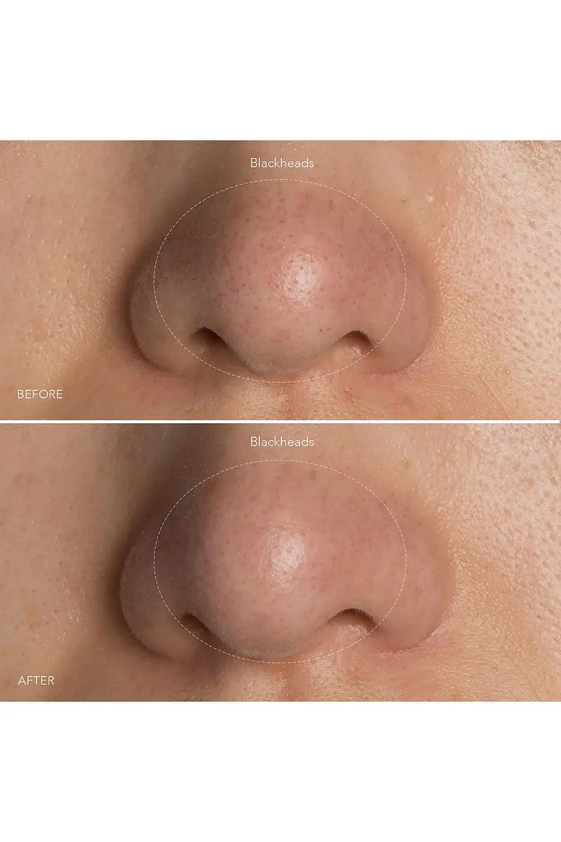 Foreo KIWI Blackhead Remover Device | Thumbnail 4 Foreo KIWI Blackhead Remover Device | Thumbnail 4