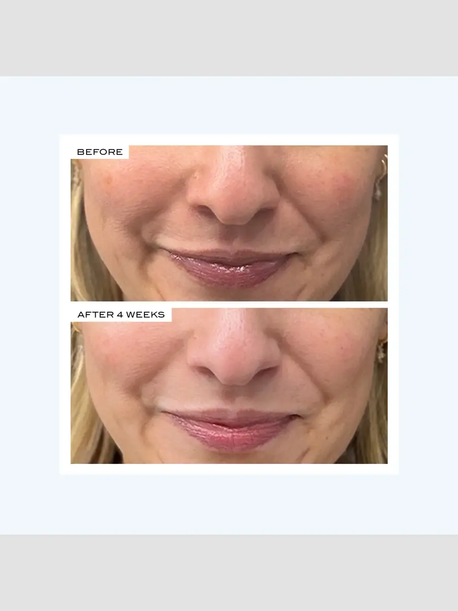 111SKIN Precision Peel | Thumbnail 6 111SKIN Precision Peel | Thumbnail 6